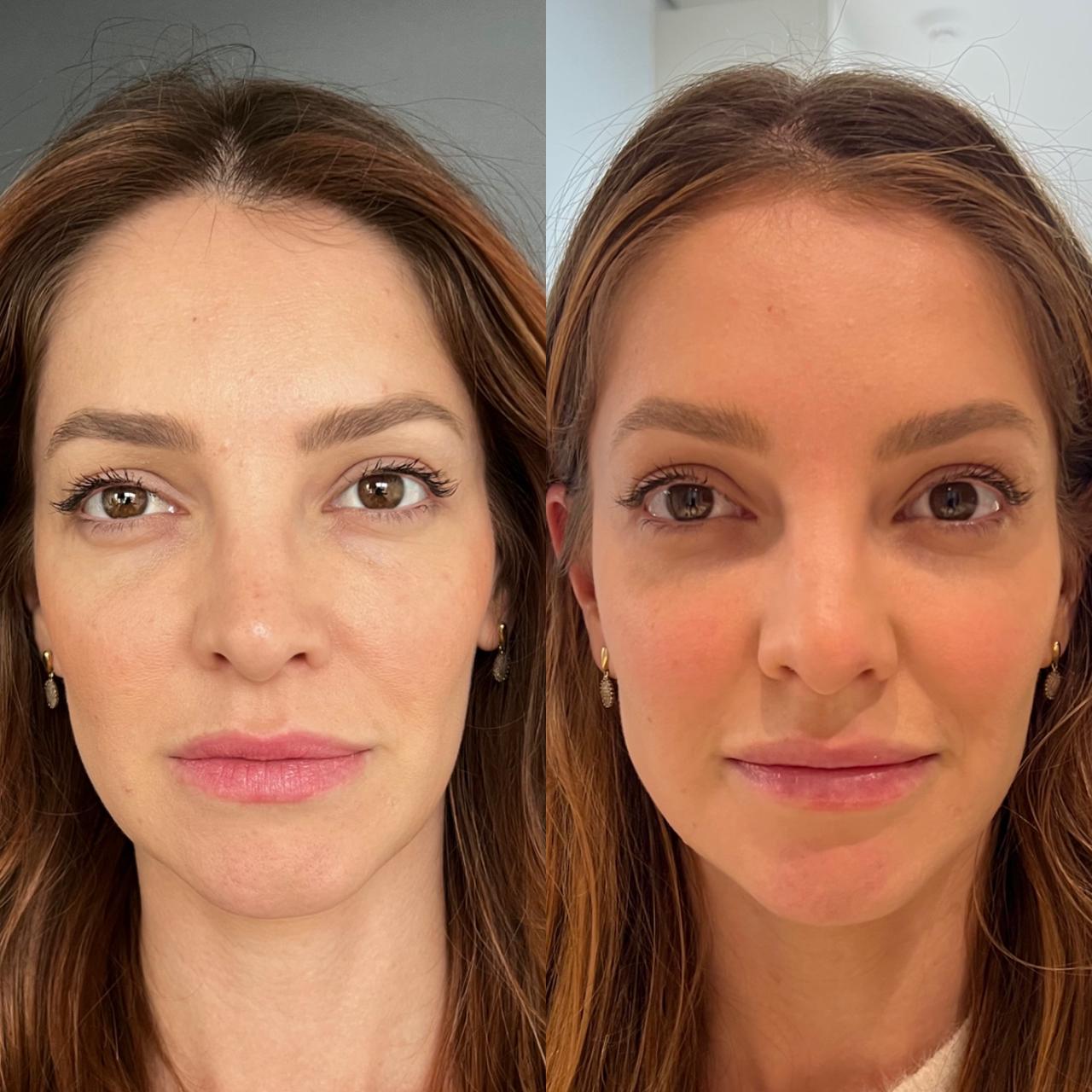 Antes e depois harmonização facial — paciente 3, vista frontal