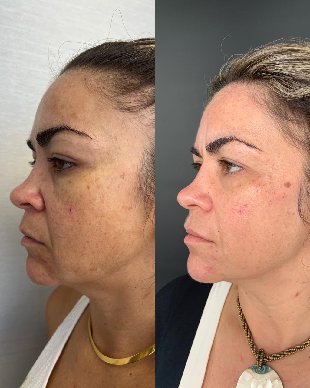 Antes e depois harmonização facial — paciente 2, vista frontal e perfil