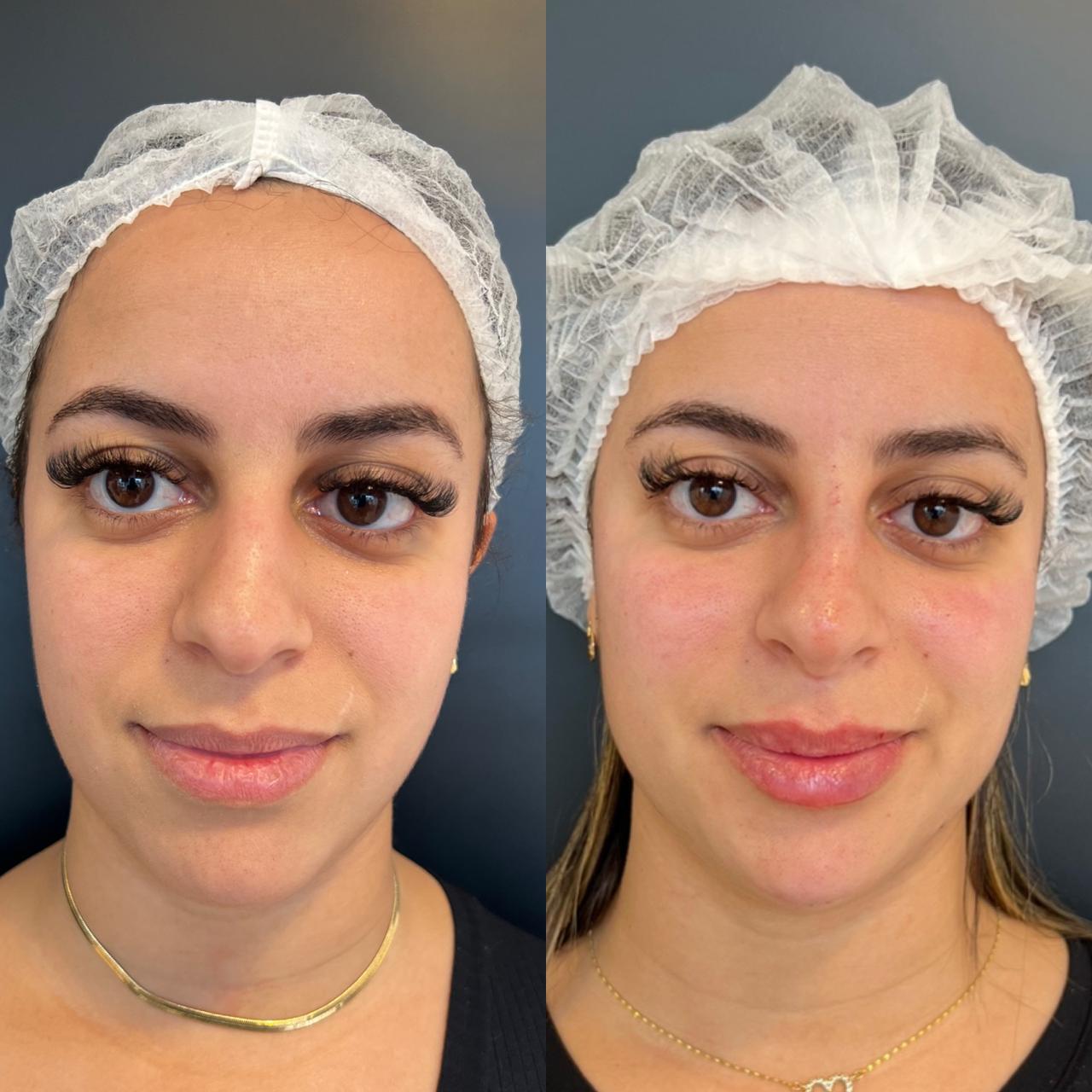 Antes e depois harmonização facial — paciente 4, múltiplos ângulos