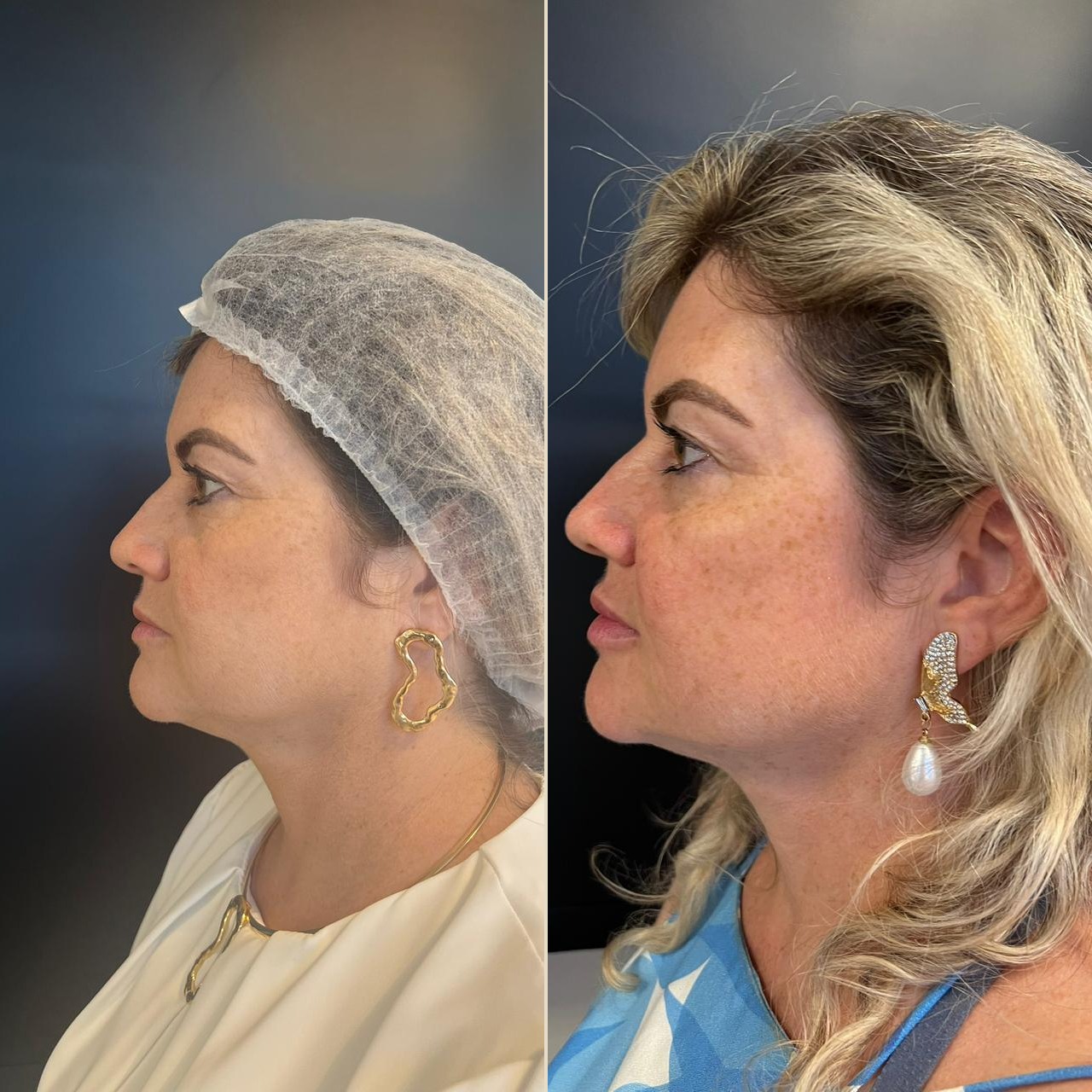 Antes e depois harmonização facial — paciente 1, perfil lateral com redefinição de queixo e pescoço